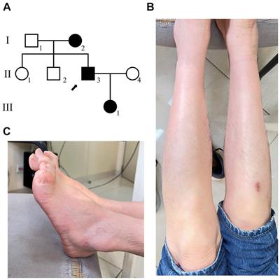 Case report: A novel variant (H49N) in Myelin Protein Zero gene is responsible for a patient with Charcot–Marie–Tooth disease